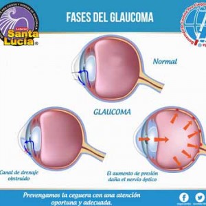 Examen de la vista gratuito en la Guatemala en marzo 2017