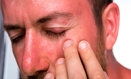Descripción de foto - Hombre con piel quemada, insolado, con los ojos cerrados. - Crédito de foto - Oncosalud