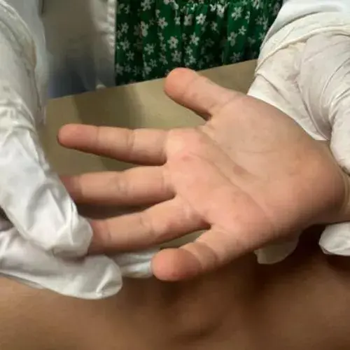 enfermedad de mano, pie y boca que afecta a niños guatemaltecos